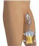 picture of a condom catheter on a male penis connected to tubing which is connected to a urine drainage bag on the thigh