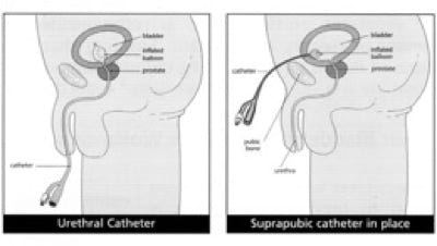 picture showing two ways a foley catheter can be put in one through the penis and the other through the abdominal wall into the bladder